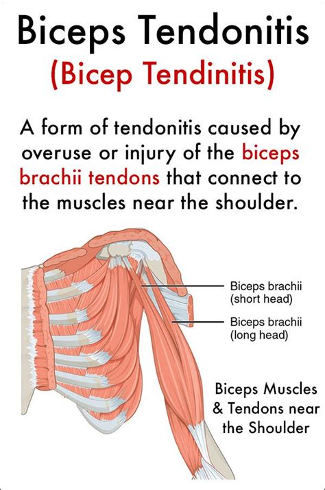 Causes Bicep Tendonitis