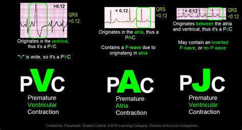 Paramedic Student Central: PVC, PAC, PJC Quick Reference Tool ...