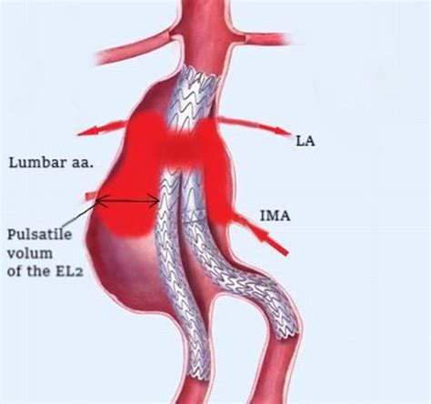 Treatment of the Progressive Endoleak Type 2 After EVAR | IntechOpen