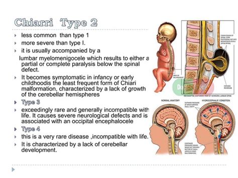 Syringomyelia ( Morvan syndrome) Electrodiagnosis