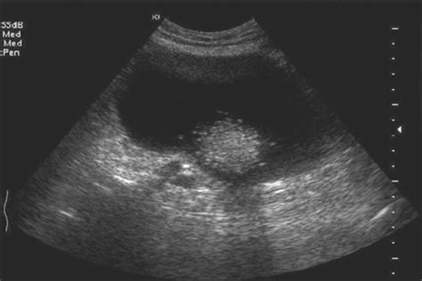 Ovarian Cystic Teratoma - Rao - 2002 - Journal of Ultrasound in Medicine - Wiley Online Library