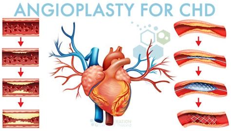 Stem Cell Therapy for Heart Disease Atherosclerosis CAD IHD