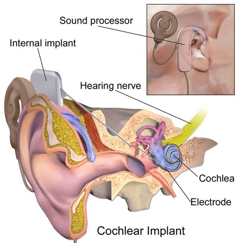 Cochlear implant - Wikipedia