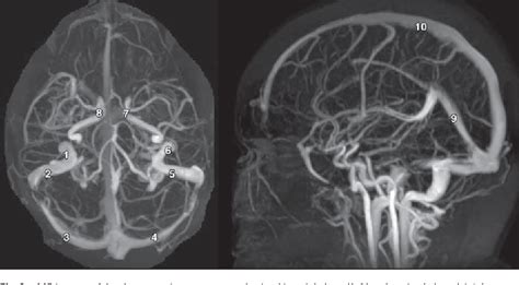 Figure 1 from Diagnostic Performance of MRI Sequences for Evaluation of Dural Venous Sinus ...