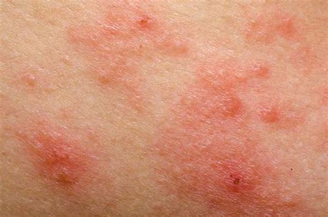 Pictures of Psoriasis (Page 5) | Psoriasis expert