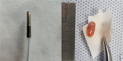 Image of a cryoprobe (A) and lung tissue specimen obtained by TBLC (B ...