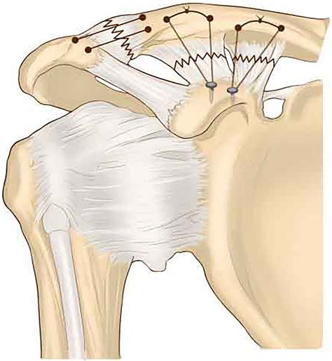 Acromioclavicular Joint Separation: Repair Through Suture Anchors for Coracoclavicular Ligament ...