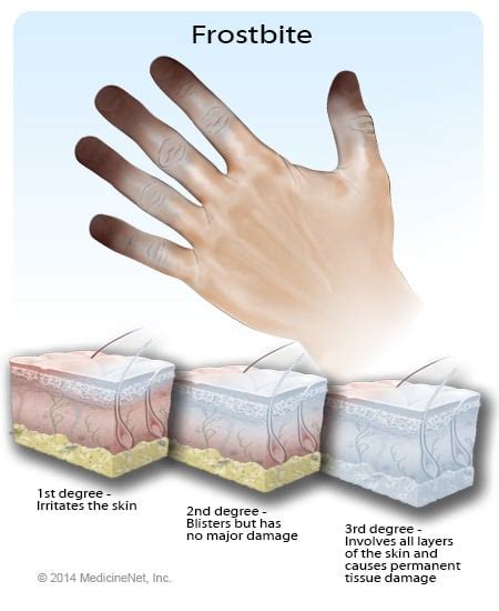 Frostbite Signs, Symptoms, Pictures & Treatment