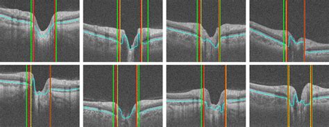 Optic disc detection results of different methods (only a rectangular ...