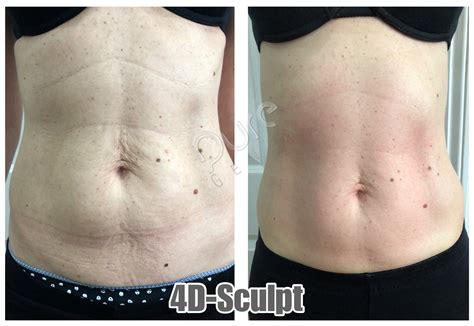 Amazing Skin Tightening Results With 4D-Sculpt - PureGenex - Inch Loss and Aesthetic Technologies