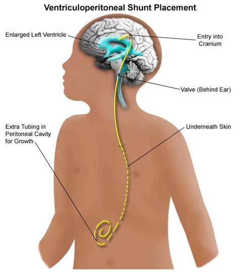 A diagram of a VP Shunt | Spinal fluid, Brain drain, Vp shunt