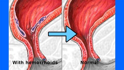 How To Get Rid Of Piles In Third Trimester at Charles Bedford blog