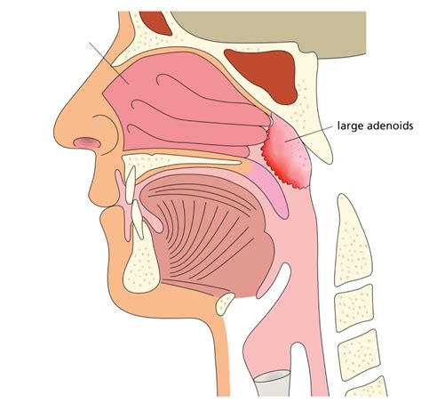 Adenoid Nose