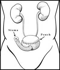 Pictures of the 3 Diversions - Bladder Cancer Support Forum