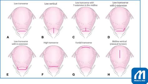 Variety of incisions for hysterotomy (15) Source :... | Download Scientific Diagram