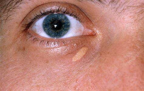 Xanthelasma deposit on lower eyelid - Stock Image - M310/0008 - Science ...