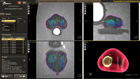 Prostate Biopsy- Smart Biopsy | San Antonio | The Urology Place