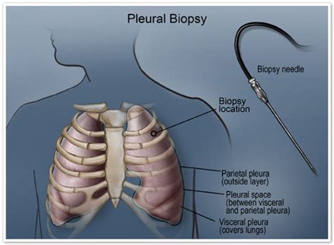 Pleural Biopsy | Take Care Mesothelioma