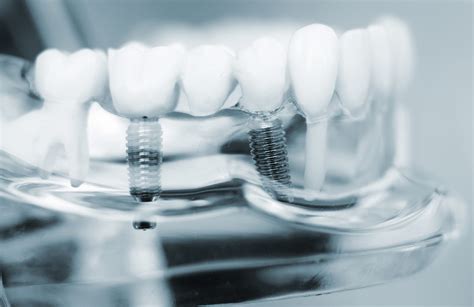 NW Houston Prosthodontics - Dental Implants - What to Expect?