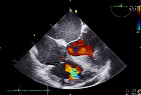 Cureus | Repair of a Supracristal Ventricular Septal Defect in an Adult