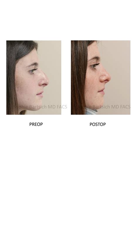 Cosmetic Facial Surgery (Nose, Eyes, and Face) Before and After Pictures