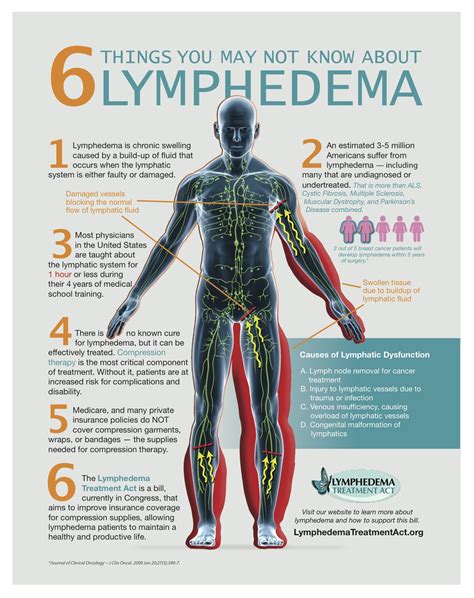 Raising Awareness for Lymphedema – The Bridge