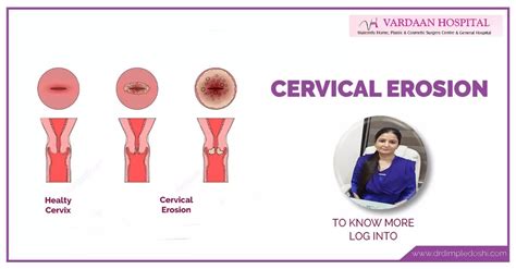 Cervical Erosion: Types, Causes, Treatment, Symptoms, Diagnosis