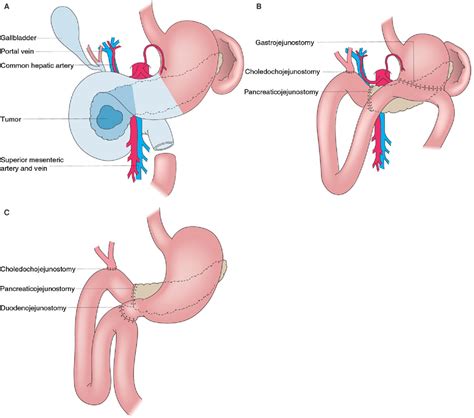 Figure 3 from The surgical management of pancreatic cancer. | Semantic ...