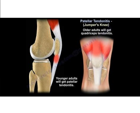 Patellar Tendinitis-Jumper’s Knee — OrthopaedicPrinciples.com