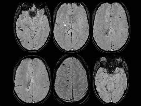 Diffuse axonal injury: CT and MRI typical findings | Eurorad