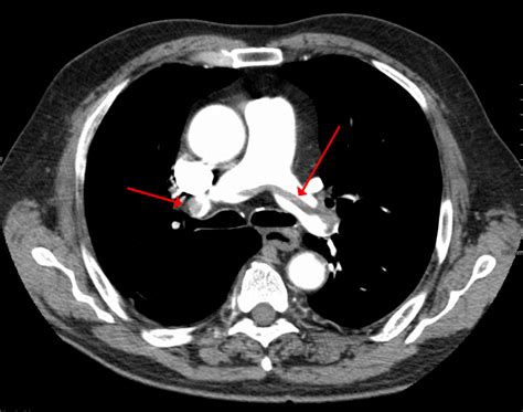 Pulmonary Embolism (PE): Causes, symptoms, diagnosis, treatment