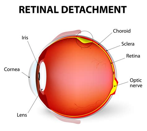 Detached Retina: Symptoms and Treatment - University Health News