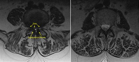 Lumbar spinal stenosis - Radiology at St. Vincent's University Hospital