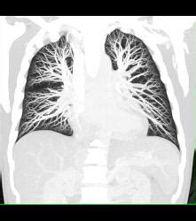 Normal Pulmonary Vasculature - Chest Case Studies - CTisus CT Scanning