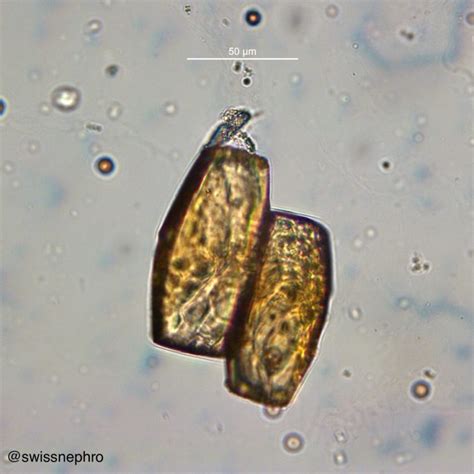 Urine Sediment of the Month: Common Crystals! - Renal Fellow Network