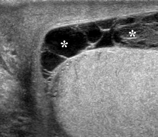 Scrotal Masses | Abdominal Key