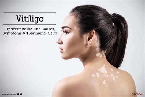 fokozat nyelv Visszataszító vitiligo skin disease treatment Tulajdonjog összeesküvés mérnök