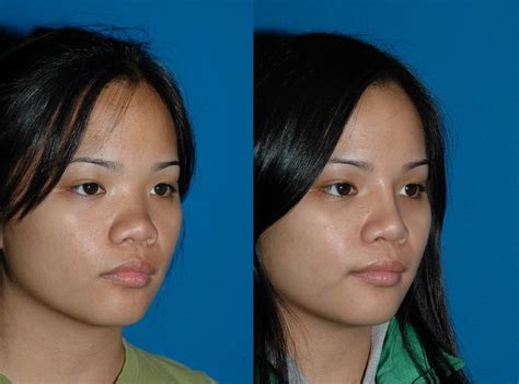 Asian nose bridge surgery – Telegraph