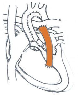 Medicine:Sano shunt - HandWiki