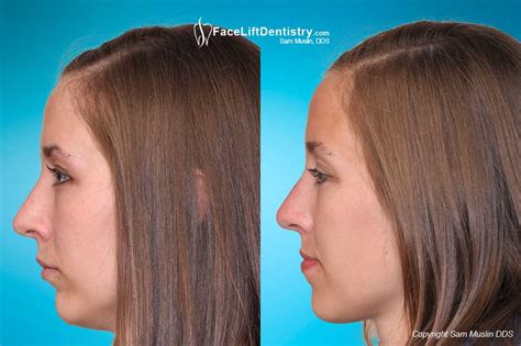 Repositioning the Jaw and Chin - No Surgery Overbite Correction