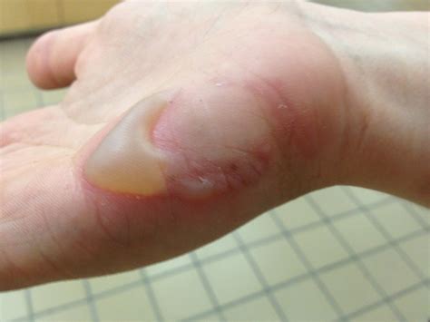 burn blister (With images) | 2nd degree burns, Degree burns, Burns