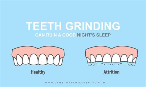 The Nightly Grind: Teeth Grinding Causes, Risks, Cures for Bruxism ...