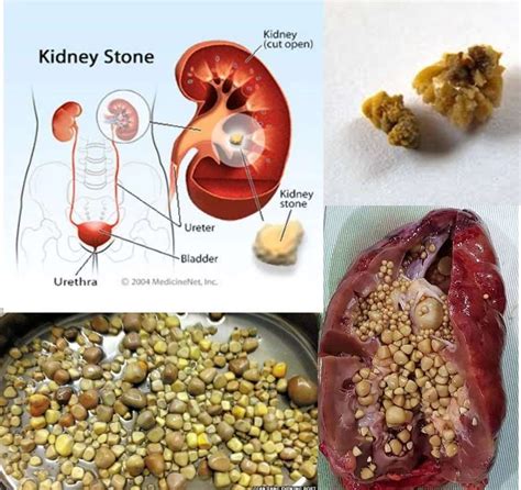 How Can You Pass A Kidney Stone - HealthyKidneyClub.com