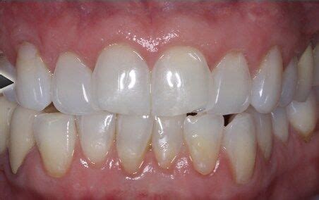 Can receding gums be reversed?