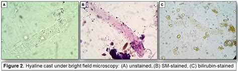 Urine Sediment of the Month: Colorless, Transparent Hyaline Casts ...