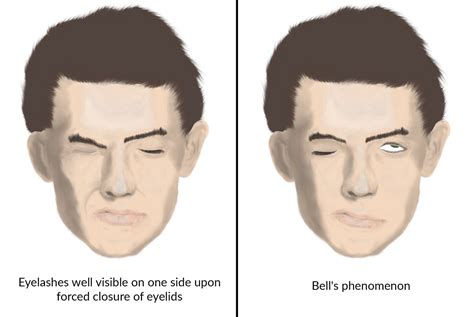 Bell S Palsy Vs Stroke Symptoms Facial Nerve Palsy Knowledge Amboss ...