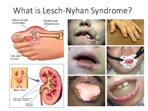 LeschNyhan Syndrome LNS and the HPRT 1 Gene