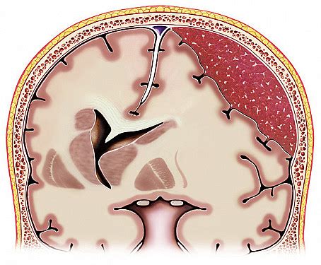 Subdural Hematoma - Harvard Health