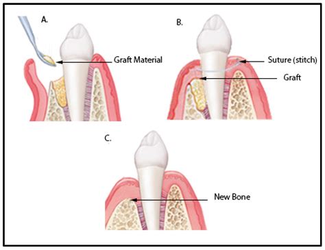 Polymers | Free Full-Text | Guided Tissue and Bone Regeneration ...