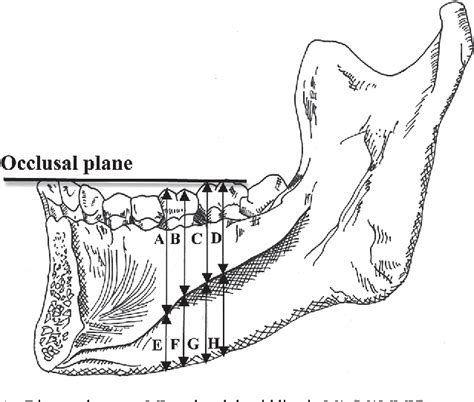 Figure 1 from Relative position of the mylohyoid line on dentulous and edentulous mandibles ...